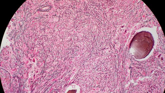 La mielofibrosis es un tumor de la sangre